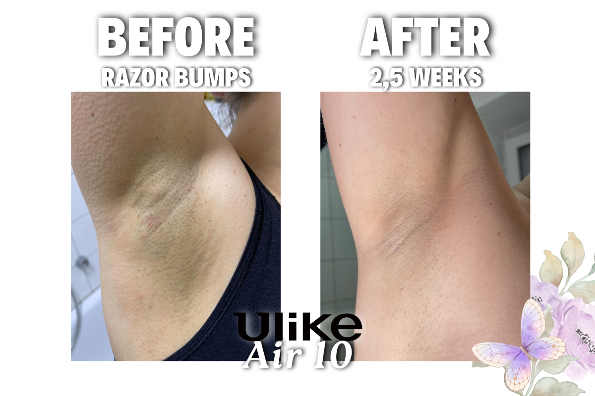 ULIKE Air 10 IPL Hair Removal Review Result Before After